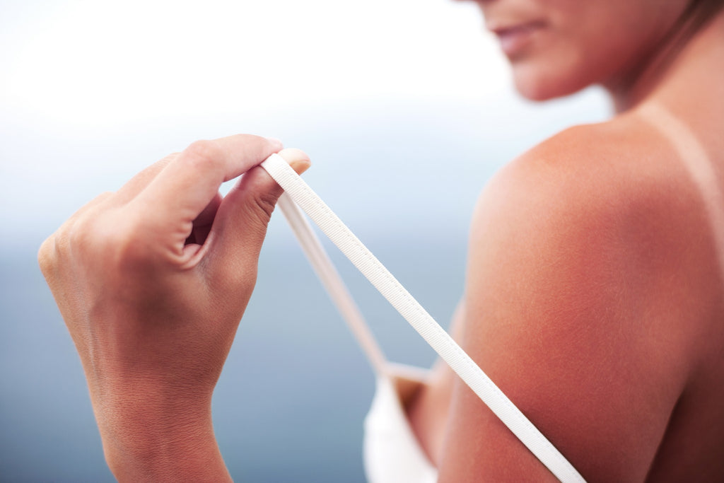 Home Remedies for Sunburn: A DIY Sunburn Treatment Lotion